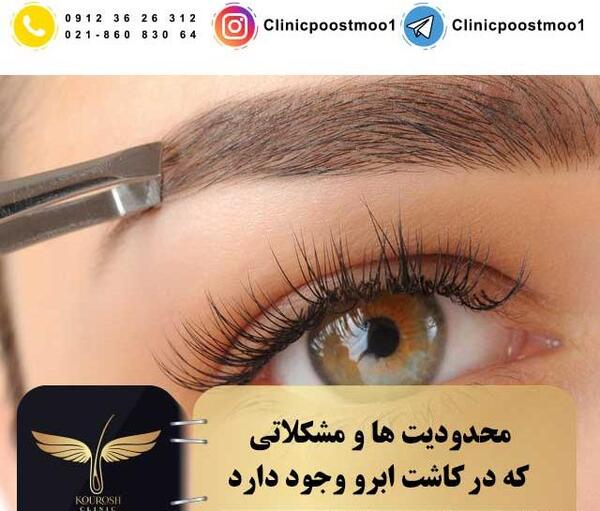 عکس کاشت ابرو