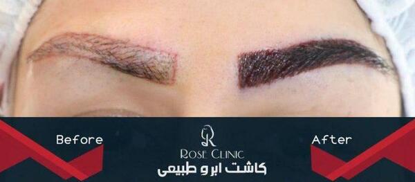 عکس کاشت ابرو