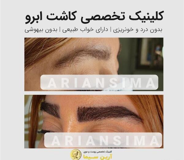 عکس کاشت ابرو