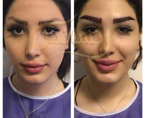 عکس کاشت ابرو
