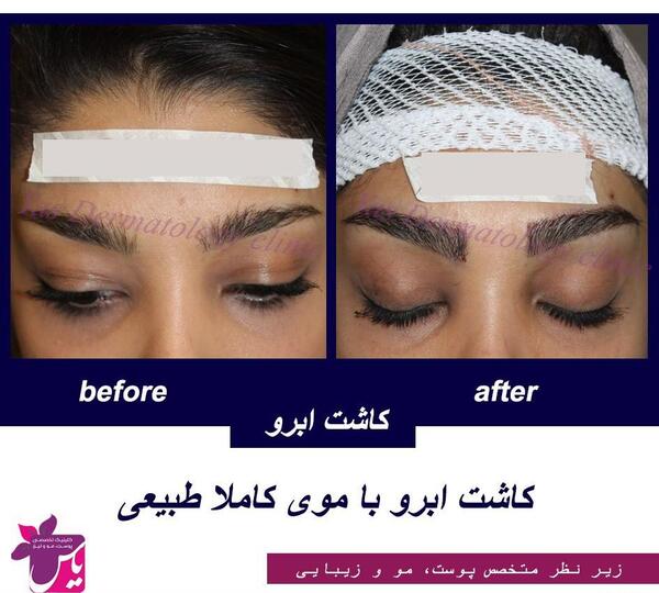 عکس کاشت ابرو