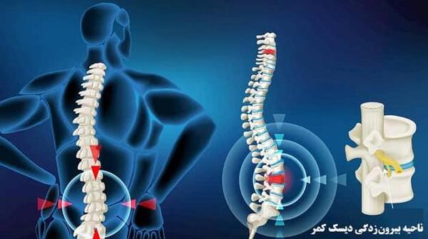 عکس ام ار ای دیسک کمر خفیف