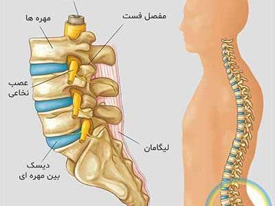 عکس ام ار ای دیسک کمر خفیف