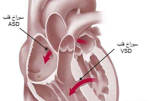 عکس قلب نوزاد
