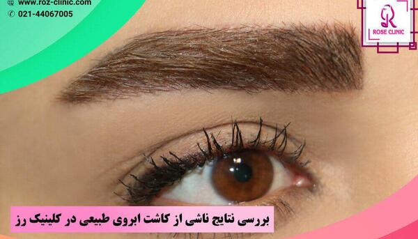 عکس جراحی کاشت ابرو
