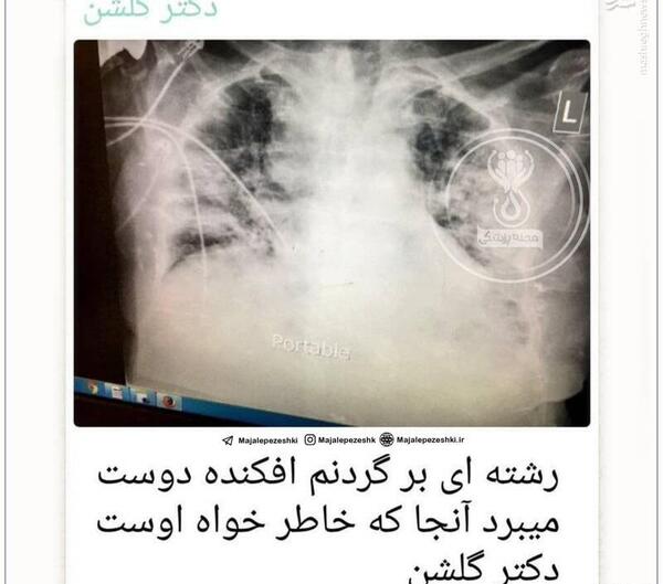 عکس ریه مشهد