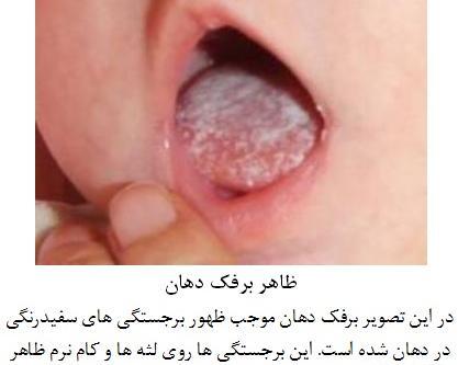 عکس برفک دهان نوزاد نی نی سایت