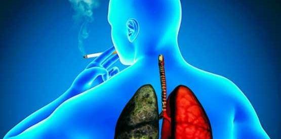 عکس ریه برونشیت
