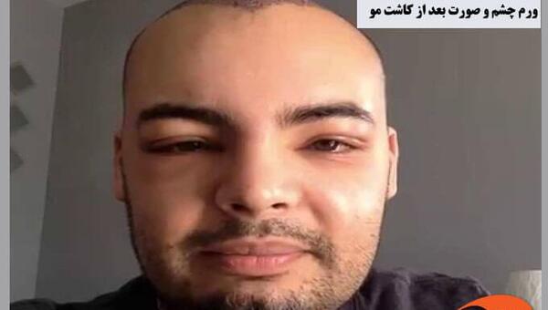 عکس حین کاشت مو