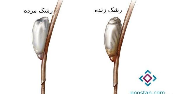 عکس شپش مرده سر