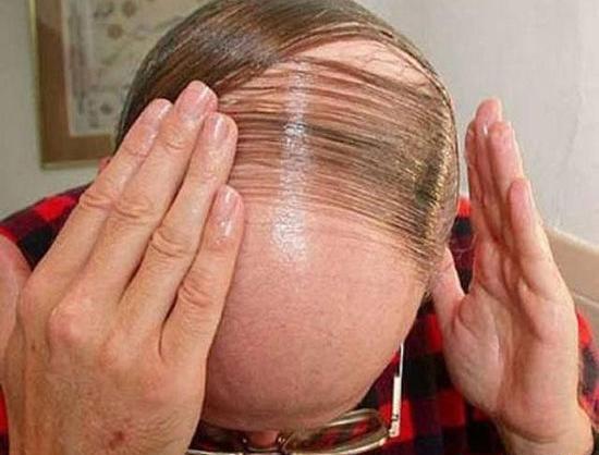 عکس مرد کچل خنده دار