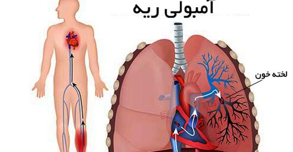 عکس ریه آمبولی