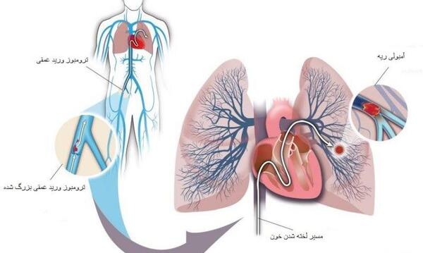 عکس ریه آمبولی