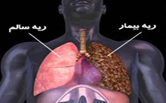 عکس ریه شیمیایی