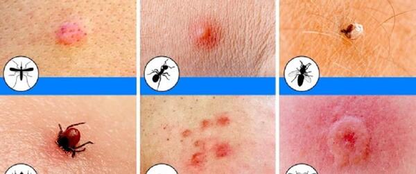 عکس گزیدگی شپش بدن