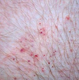 عکس گزیدگی شپش بدن