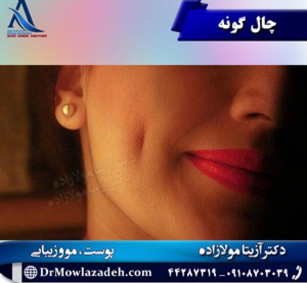 عکس فانتزی چال گونه