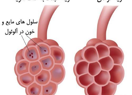عکس ذات ریه