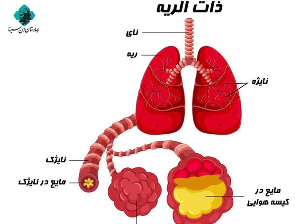 عکس ذات ریه