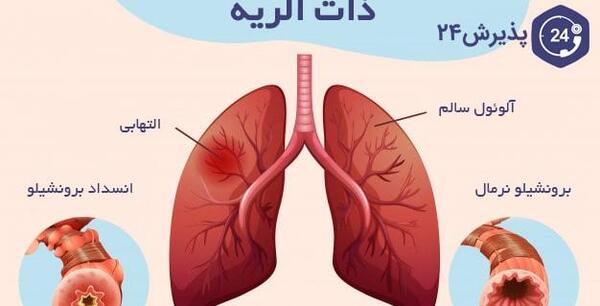 عکس ذات ریه