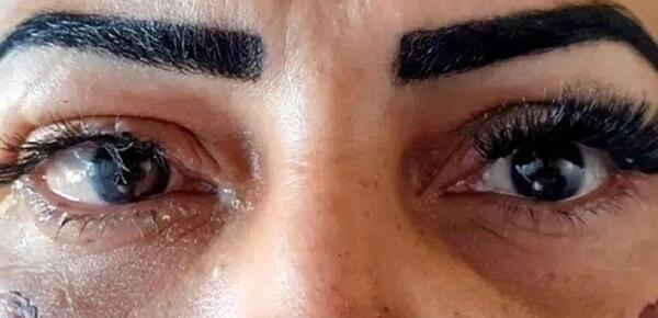 عکس عوارض کاشت مژه