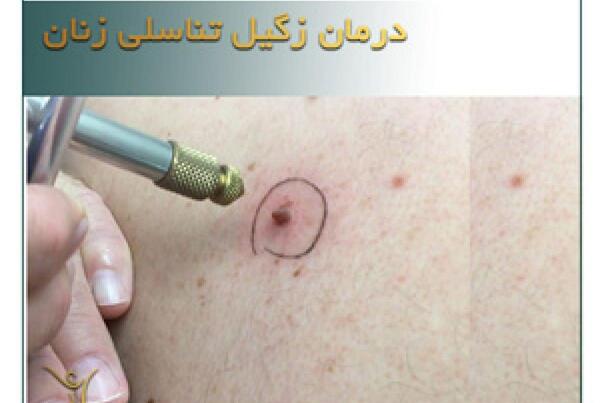 عکس ویروس تناسلی