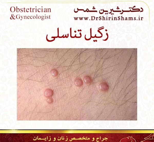 عکس ویروس تناسلی