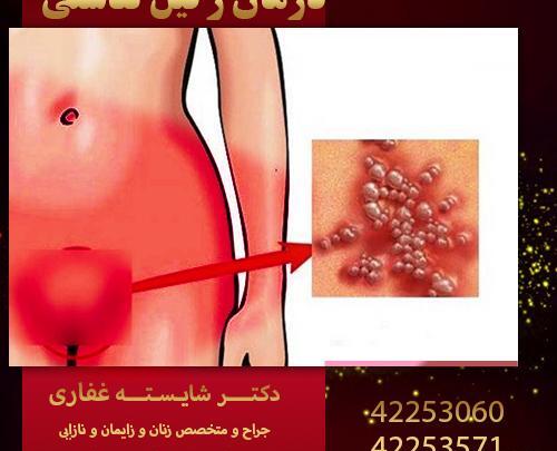 عکس ویروس تناسلی