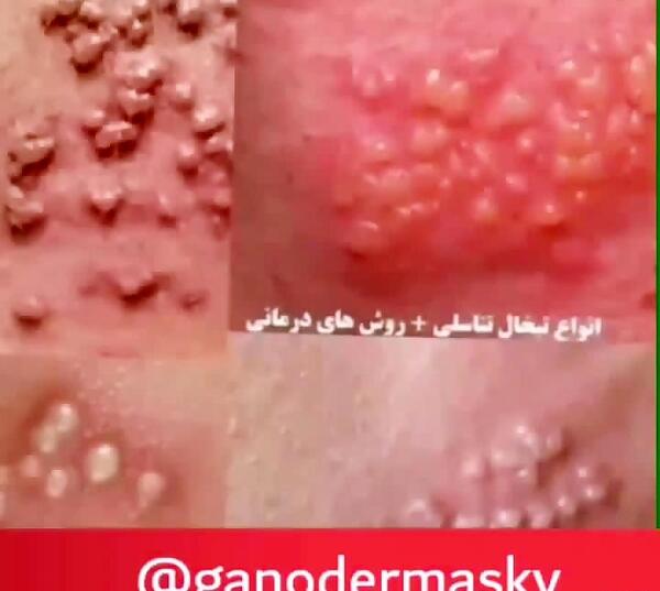 عکس ویروس تناسلی