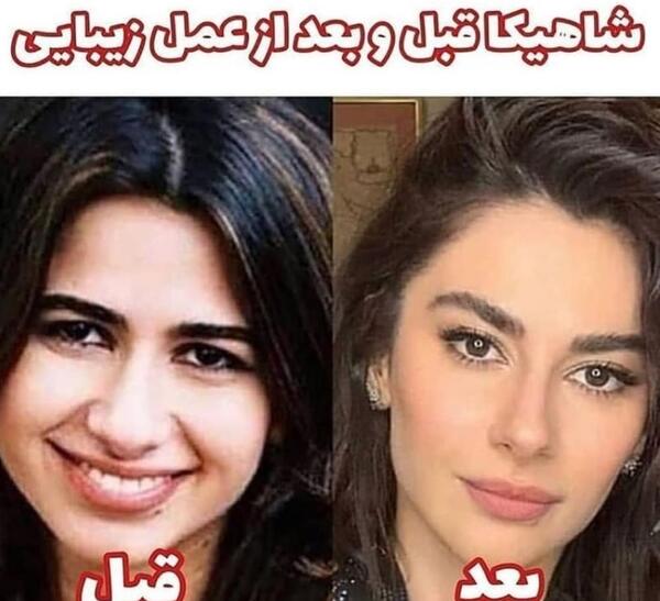 عکس قبل عمل شاهیکا