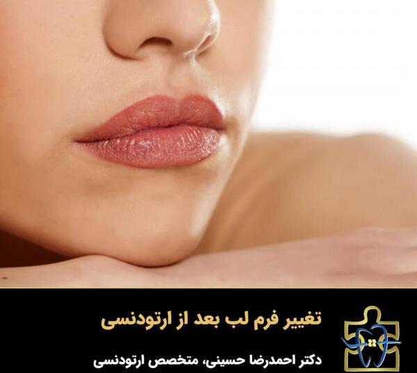 عکس لب کج