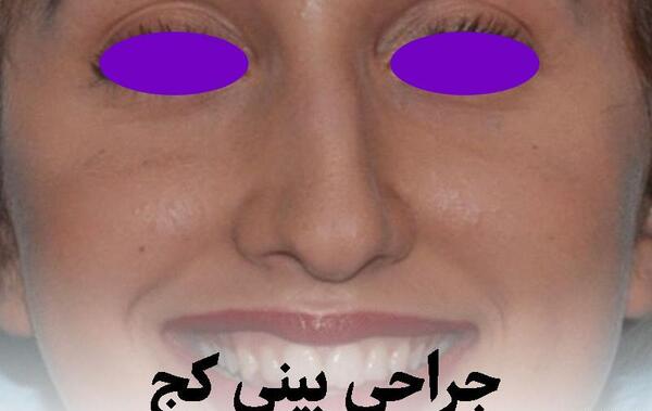 عکس لب کج