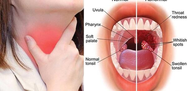 عکس داخل گلوی انسان