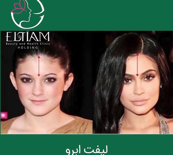 عکس قبل عمل کایلی جنر