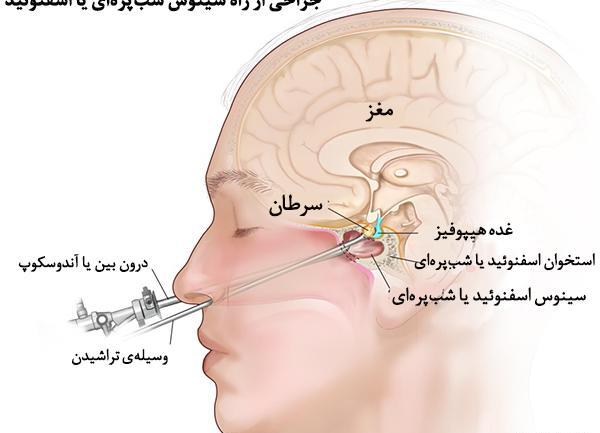 عکس ام ار ای غده هیپوفیز