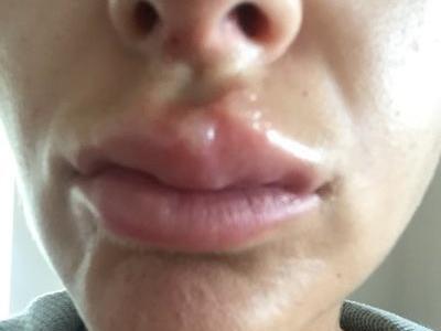 عکس تزریق ژل لب نی نی سایت
