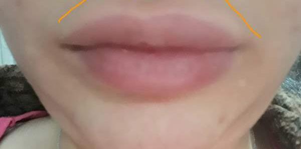 عکس تزریق ژل لب نی نی سایت