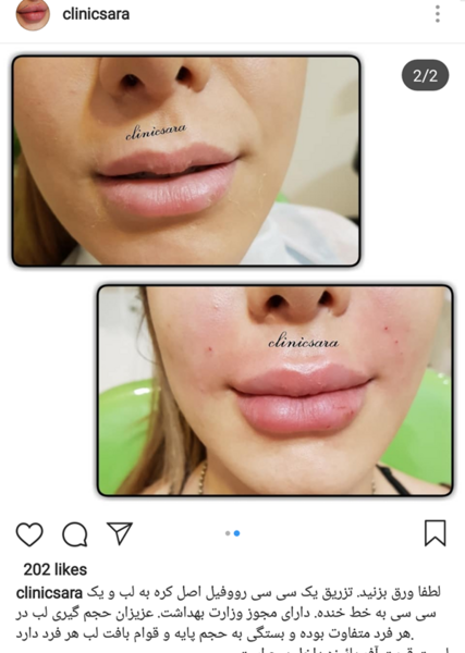عکس تزریق ژل لب نی نی سایت
