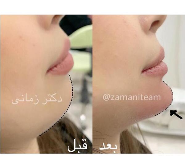 عکس تزریق ژل لب نی نی سایت