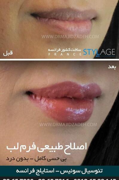 عکس تزریق ژل لب نی نی سایت