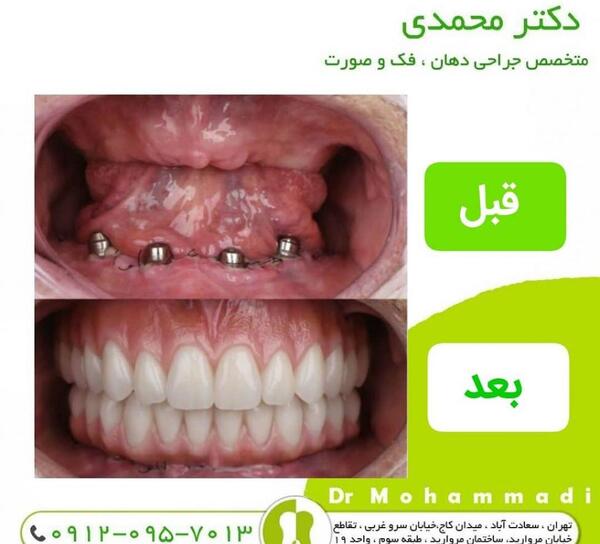 عکس کاشت ایمپلنت