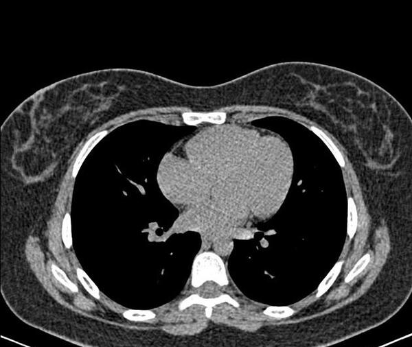 عکس تست ریه نرمال