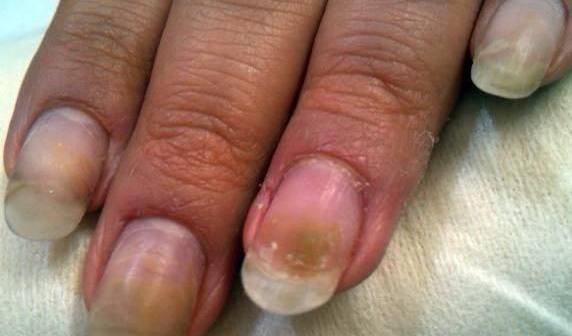 عکس قارچ کاشت ناخن
