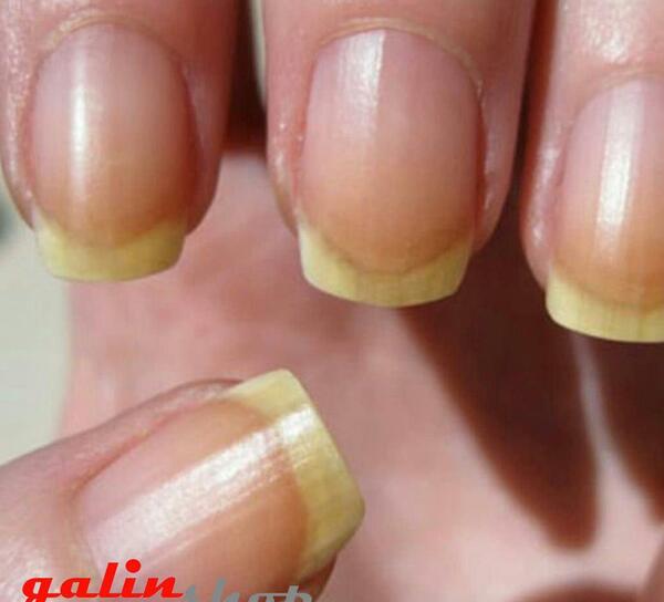 عکس قارچ کاشت ناخن
