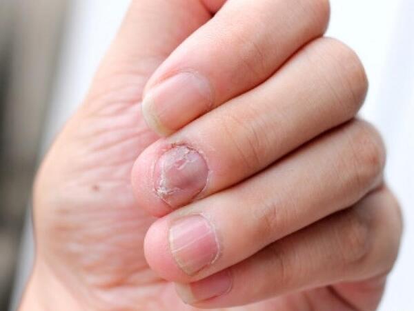 عکس قارچ کاشت ناخن