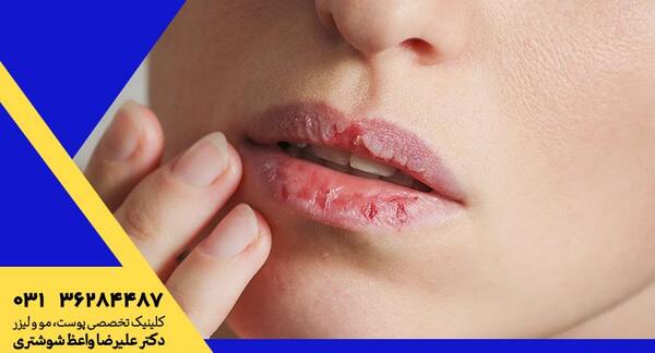 عکس لب های زخمی