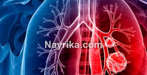 عکس سرطان ریه پیشرفته