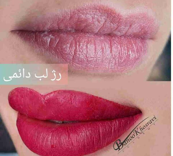 عکس کاشت رژلب