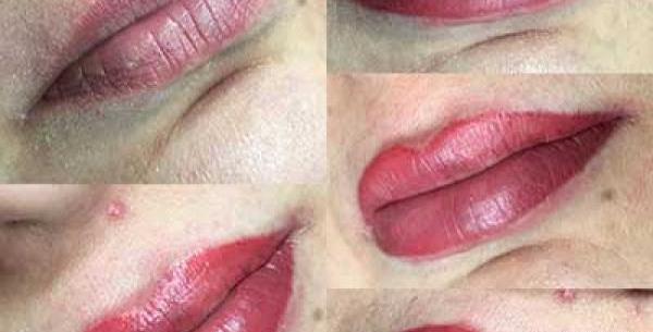 عکس کاشت رژلب