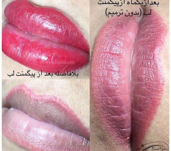 عکس کاشت رژلب